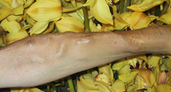 This is a picture of a Fistula